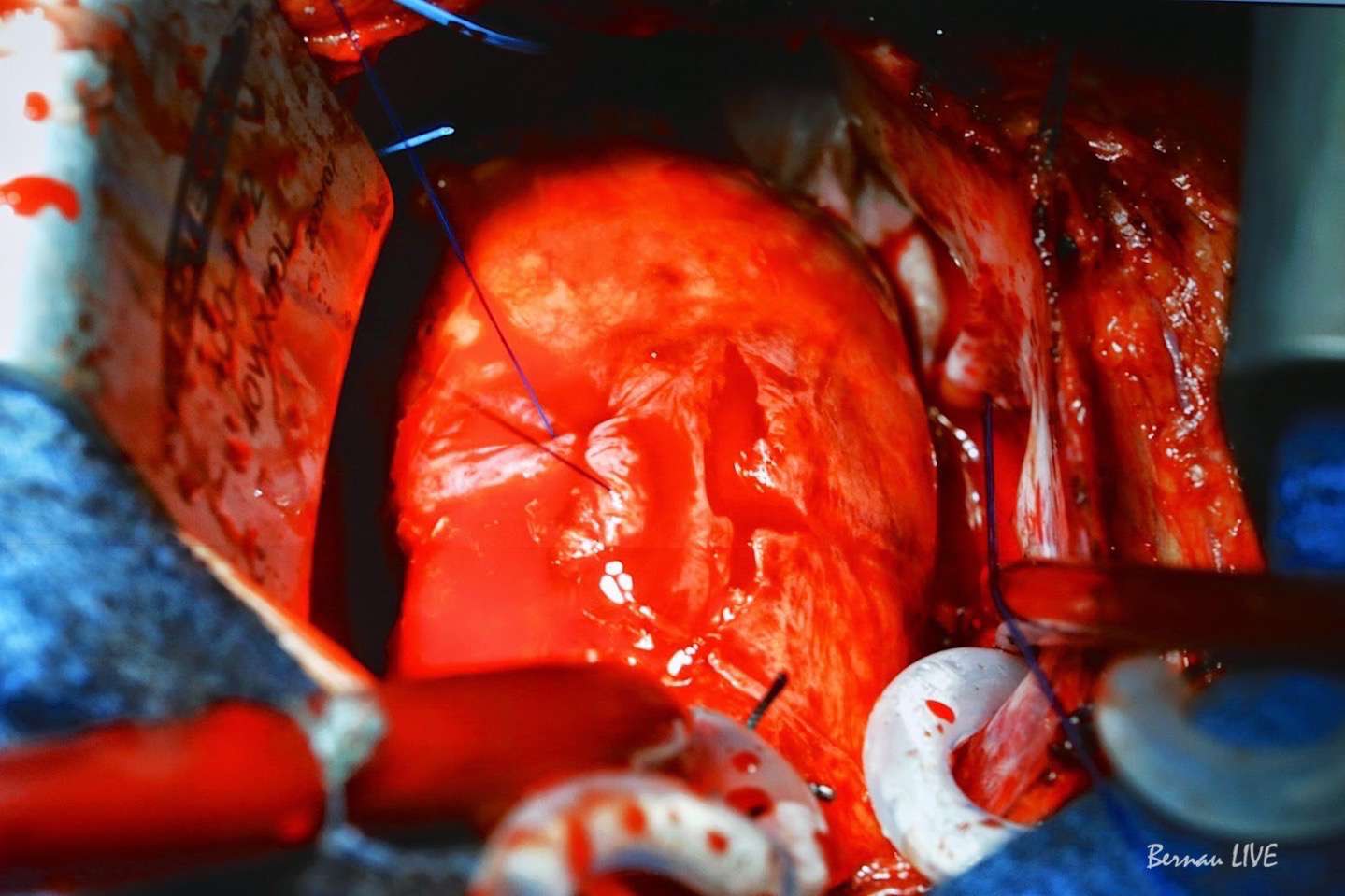 Modernste Medizintechnik aus dem Herzzentrum Bernau im TV 3 Modernste Medizintechnik aus dem Herzzentrum Bernau im TV